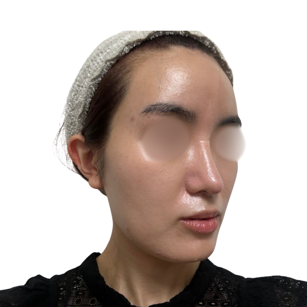 バイオリピール（ミラノリピール）